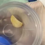 akcigerine sarimsak kacti ameliyat ile cikarildi qsiyn4EM