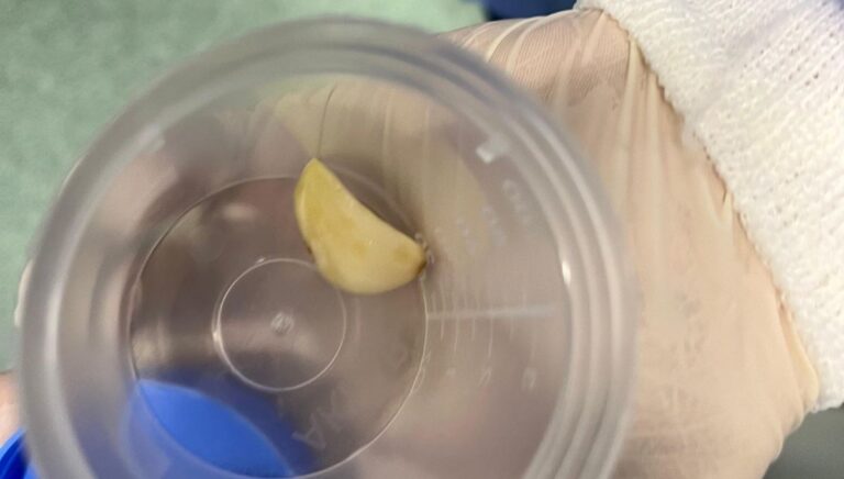 akcigerine sarimsak kacti ameliyat ile cikarildi qsiyn4EM